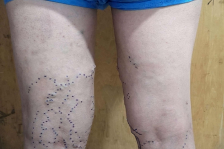 大隐静脉曲张腿部血管肿大隆出图