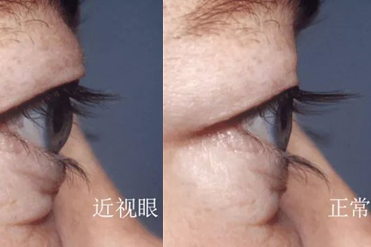 近视眼眼球突出对比图