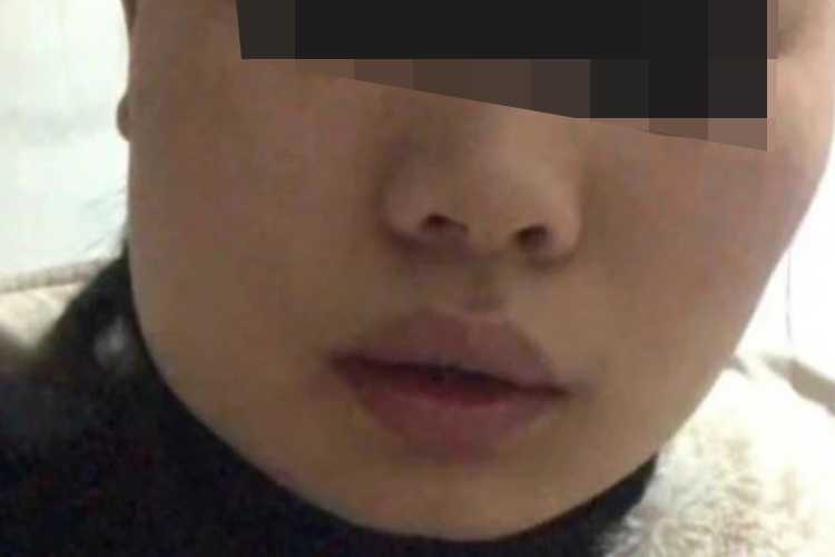 拔智齿第一天图