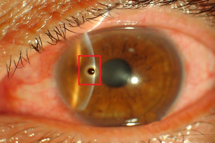角膜异物症状图 角膜异物症状图