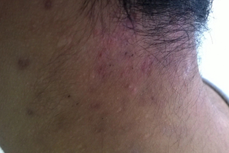 嗜酸性脓疱性毛囊炎后颈斑图 嗜酸性脓疱性毛囊炎后颈斑图