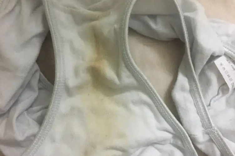 萎缩性阴道炎分泌物发黄图 萎缩性阴道炎分泌物发黄图