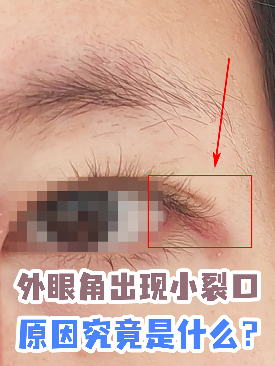 外眼角出现小裂口,原因究竟是什么?
