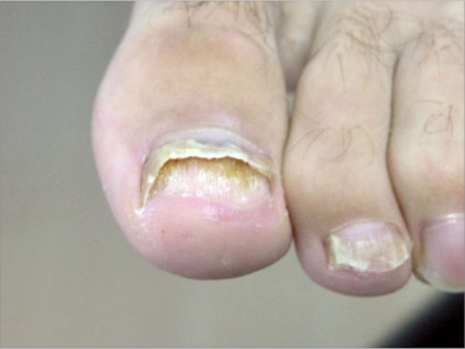 银屑病甲脚趾甲上翘图 银屑病甲脚趾甲上翘图