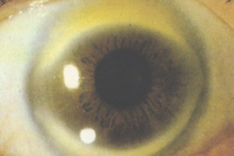 角膜老年环角膜边缘有黄斑图 角膜老年环角膜边缘有黄斑图