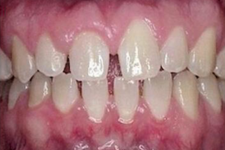 牙弓宽大牙齿不平整图