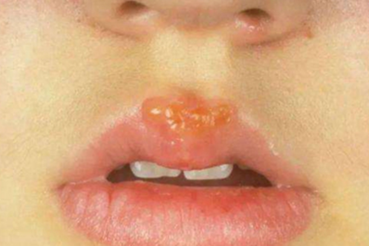 脓疱疮嘴唇水疱图