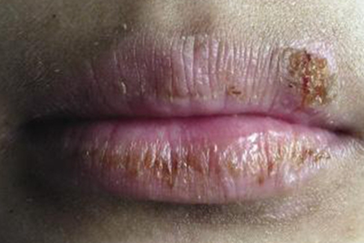 剥脱性唇炎嘴唇结黄痂图