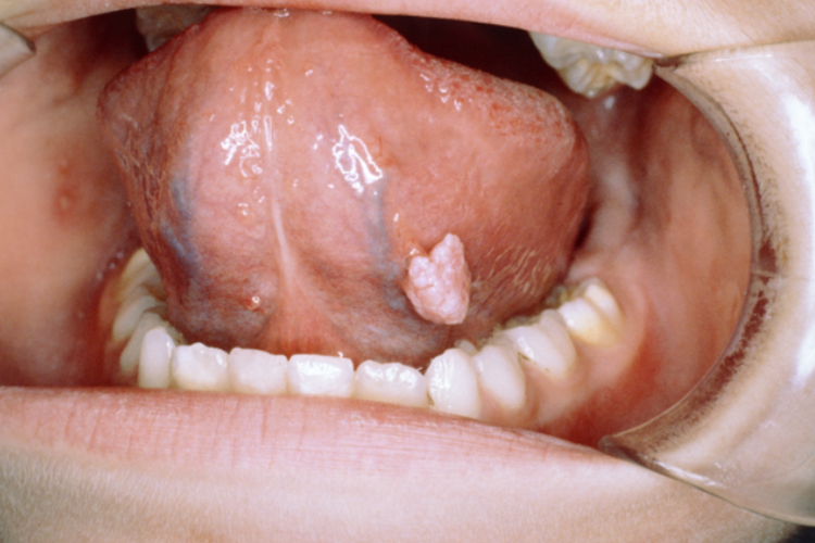 尖锐湿疣乳头状瘤图