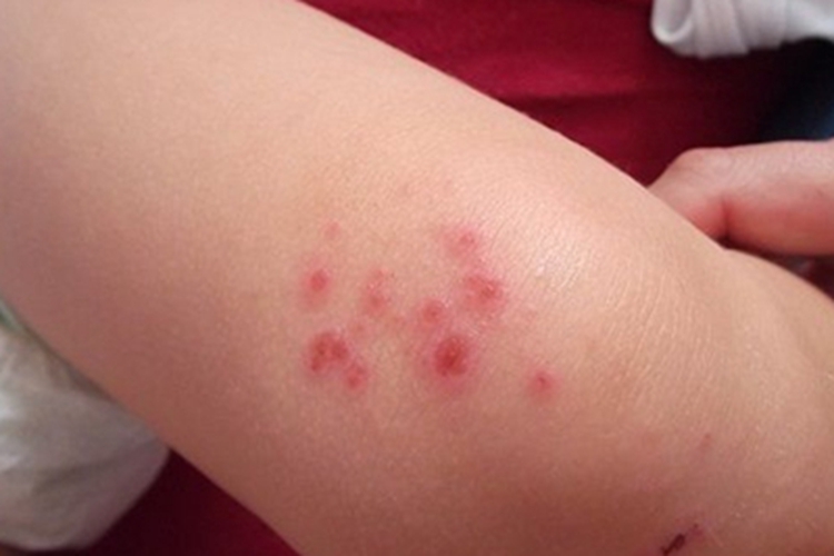 新生儿中毒性红斑症状图