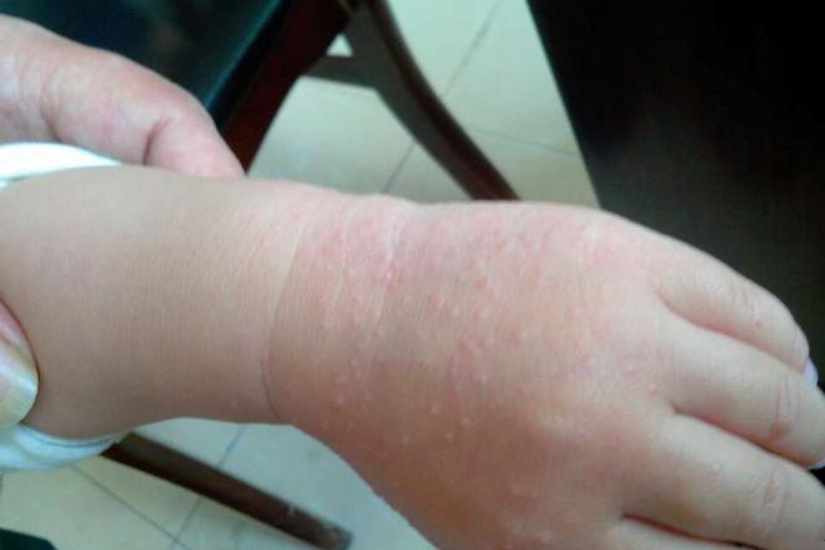 十个月宝宝湿疹起红疙瘩图