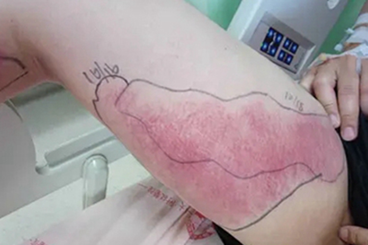 毒蛇咬伤大腿上有红色瘀斑图 毒蛇咬伤大腿上有红色瘀斑图