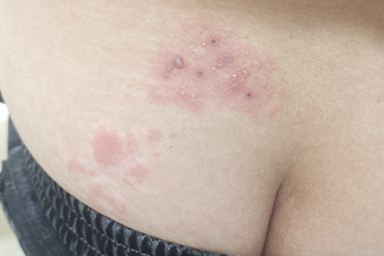 带状疱疹臀部出现红斑图