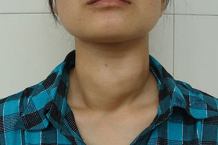 单纯性甲状腺肿前颈结节图