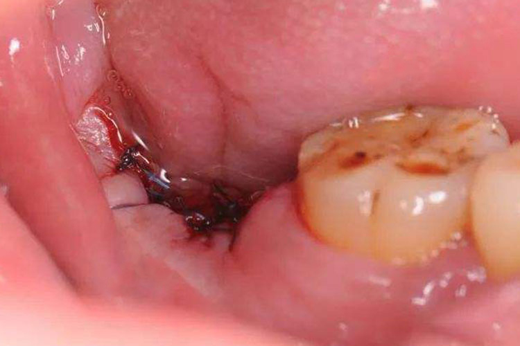 干槽症牙洞腐败血凝块图