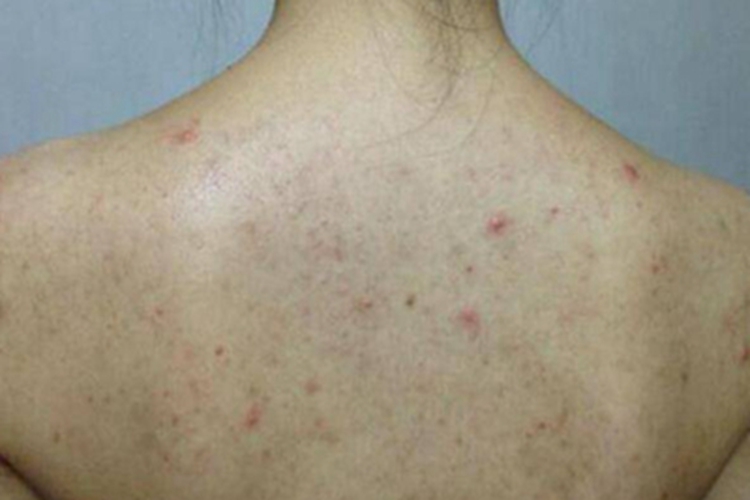 淋巴瘤样丘疹病背部小红疙瘩图 淋巴瘤样丘疹病背部小红疙瘩图
