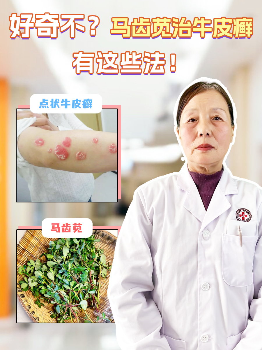 好奇不?马齿苋治牛皮癣有这些法!