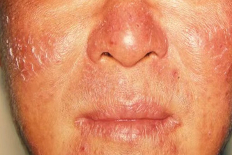 慢性光线性皮炎面部症状图 慢性光线性皮炎面部症状图