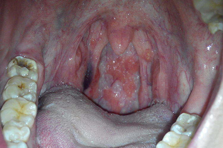 扁桃体潴留囊肿图