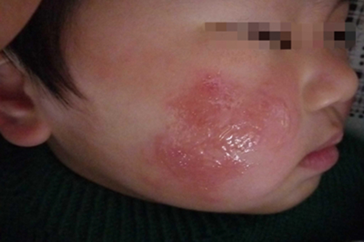 冻疮面部症状图