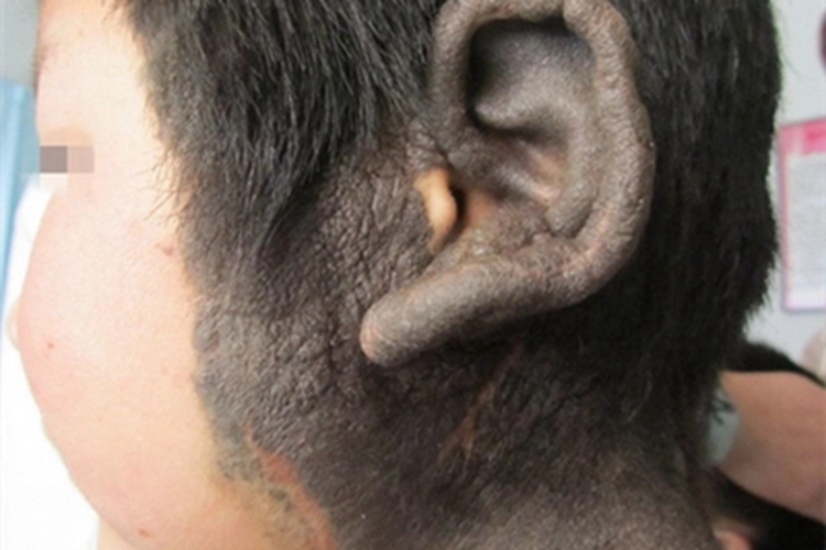 兽皮痣头部症状图 兽皮痣头部症状图