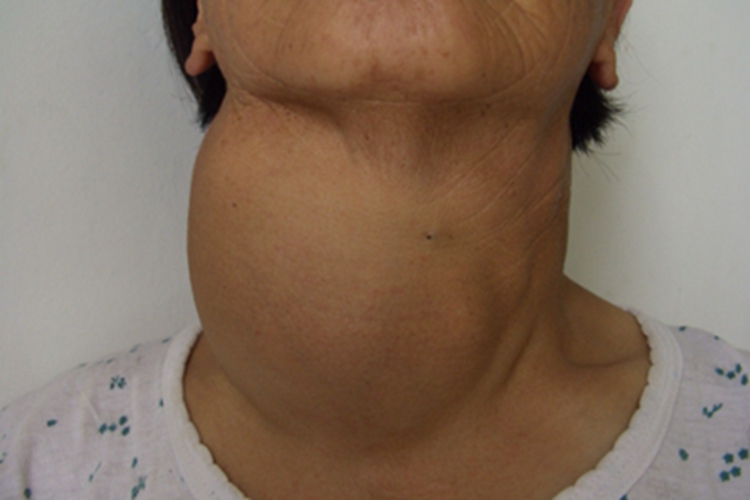 单纯性甲状腺肿侧颈大包图