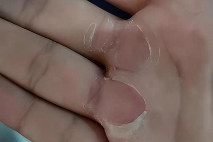胼胝手掌大片红斑脱皮图