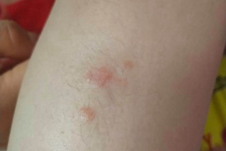 寻常型儿童银屑病胳膊症状图