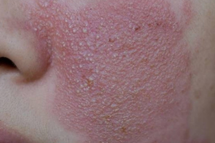 皮炎型化妆品皮炎皮肤粗糙图