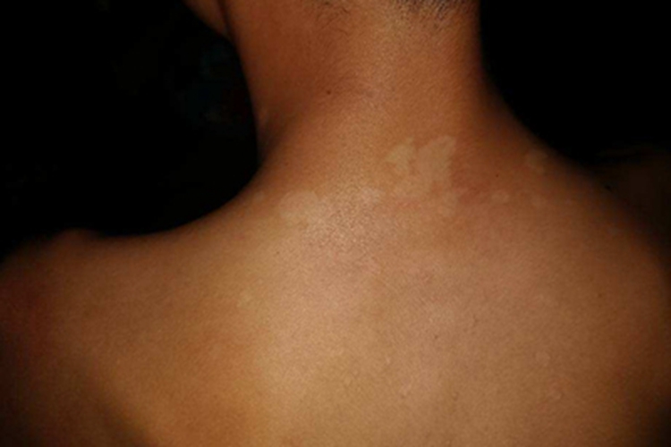 结节性硬化症背部白斑图 结节性硬化症背部白斑图