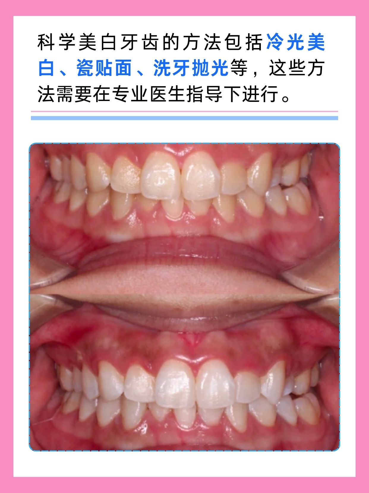 谣言还是科学？用醋刷牙真的可以美白吗？