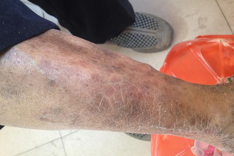 腿上皮肤色素沉着图