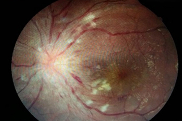 高血压视网膜病变水肿图