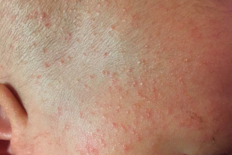 婴儿面部红痱图 婴儿面部红痱图