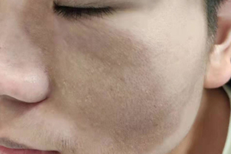 太田痣脸上一片棕褐色斑块图 太田痣脸上一片棕褐色斑块图