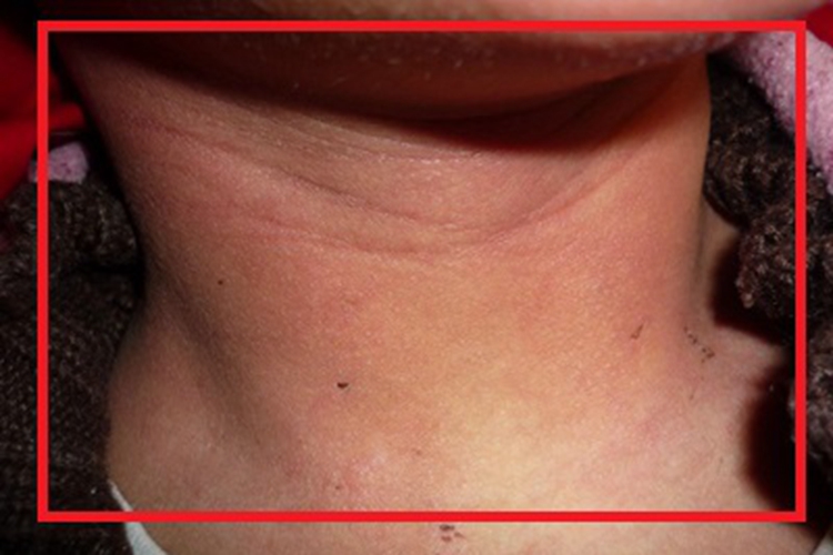 脓疱病前颈红肿图