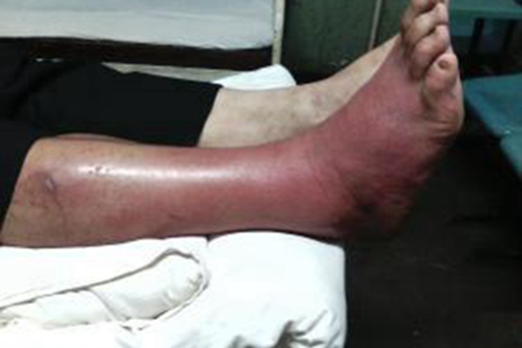 丹毒脚踝周围红肿发亮图 丹毒脚踝周围红肿发亮图