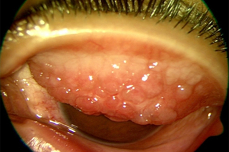 特应性角结膜炎症状图 特应性角结膜炎症状图