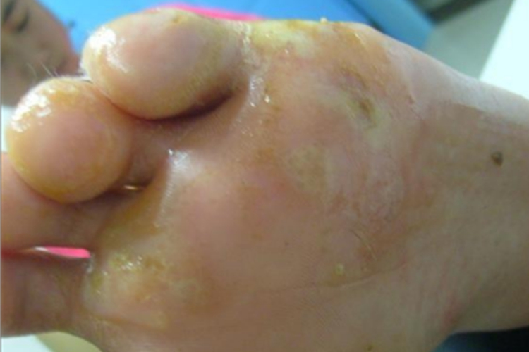 癣菌疹脚部渗液图