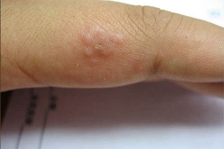 单纯疱疹手指症状图