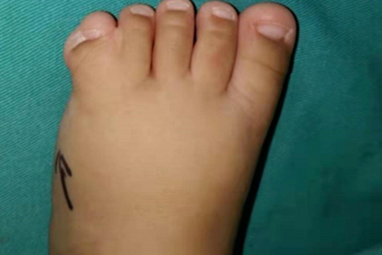并趾畸形脚趾完全融合图