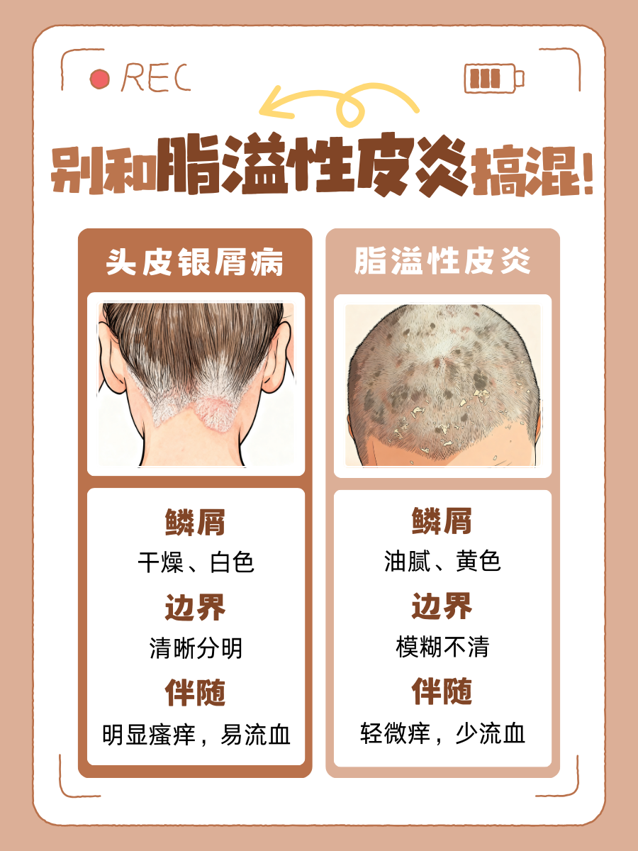 头皮银屑病图片|别把头屑当小事！