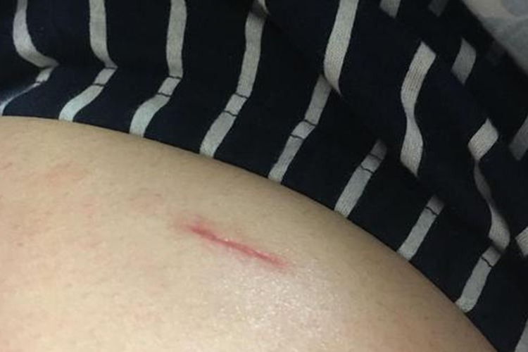 腹腔镜术后线性瘢痕图