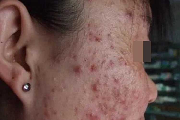 痤疮面部布满红疙瘩破溃结痂图 痤疮面部布满红疙瘩破溃结痂图