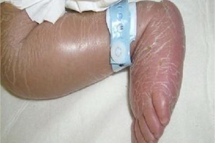 维生素E缺乏症水肿图