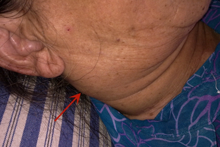 女性艾滋病淋巴结肿大图 女性艾滋病淋巴结肿大图