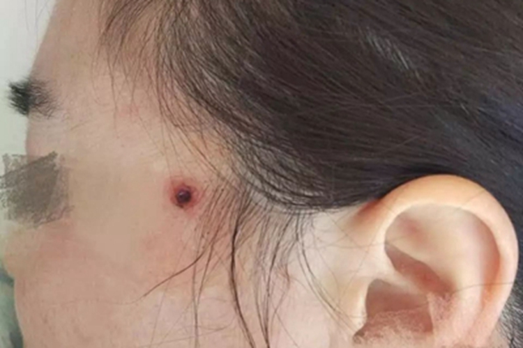 化脓性肉芽肿颞部结痂图 化脓性肉芽肿颞部结痂图