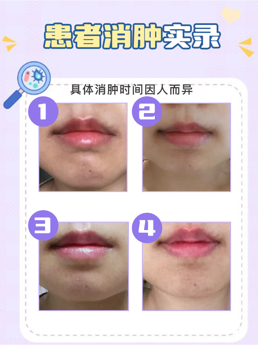 种植牙肿几天能消肿？看完你就知道！