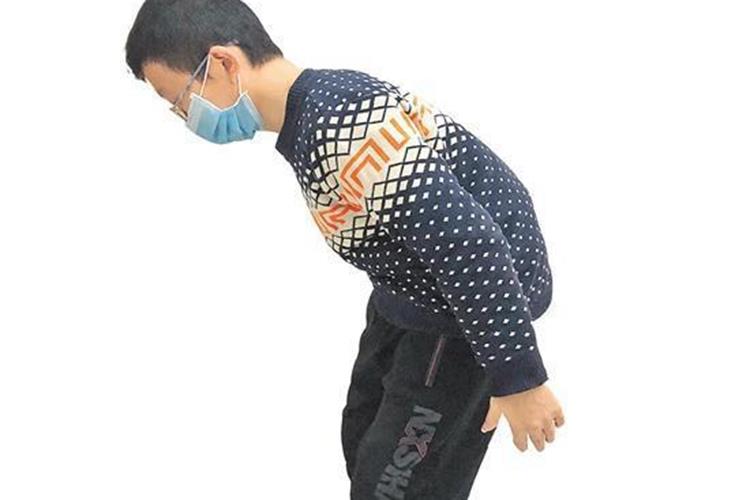 脊柱变形后凸图