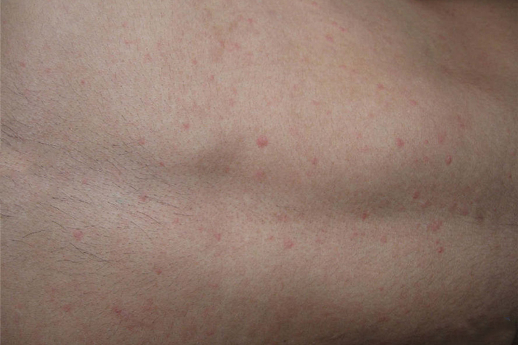 胆碱能性荨麻疹早期图